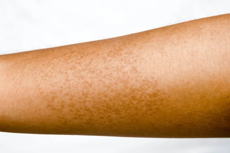 Веснушки на лице у детей. Пигмент у ребенка. Пигмент у ребенка. Пигмент у ребенка. Пигментация на лице у ребенка.