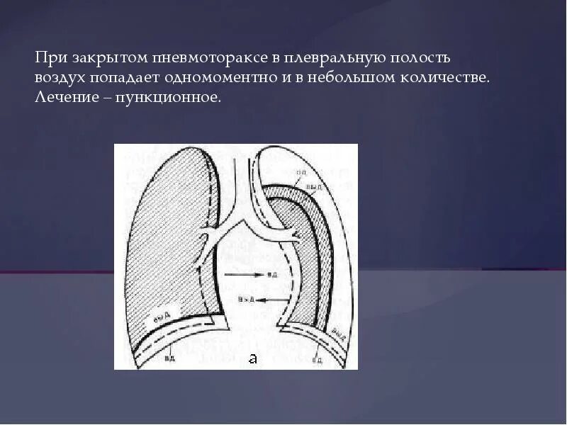 Попадание воздуха в полость. Закрытый пневмоторакс. Операция при пневмотораксе. При закрытом пневмотораксе. Операция при открытом пневмотораксе.