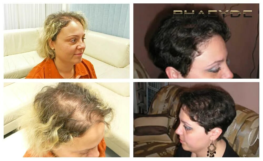 Трансплантация волос у женщин. Стрижки при выпадении волос. Волосы после химиотерапии. Прическа после химиотерапии.