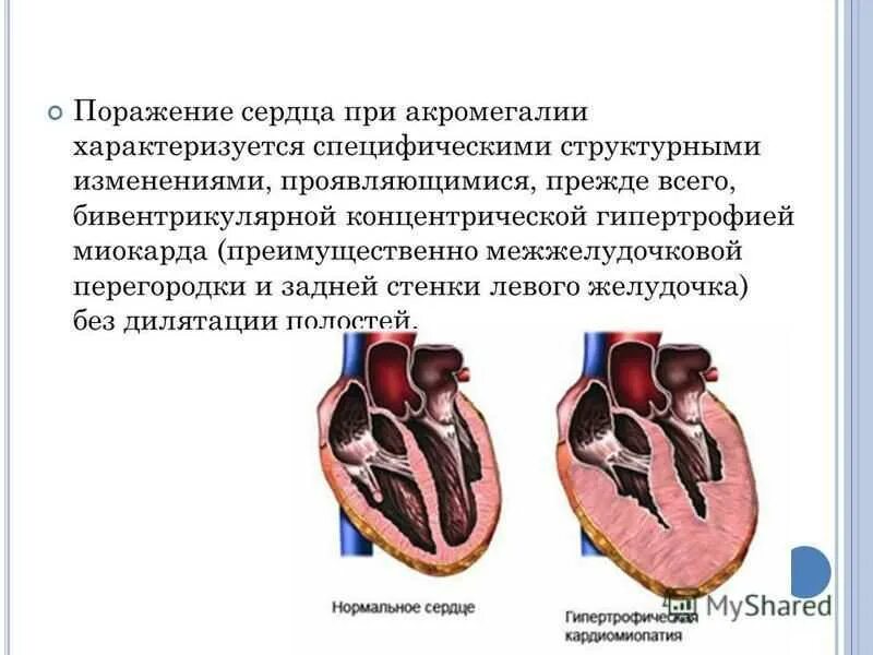 Заболевания левого желудочка. Гипертрофия миокарда МЖП. Гипертрофия межжелудочковой перегородки сердца причины. Умеренная гипертрофия миокарда межжелудочковой перегородки. Гипертрофия базального отдела МЖП.