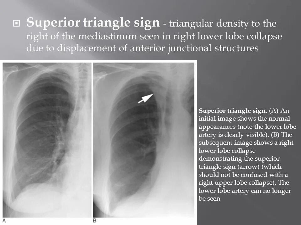 Left lower Lobe Collapse. Triangular Cord sign. Superior segment of right lower Lobe. Sang right