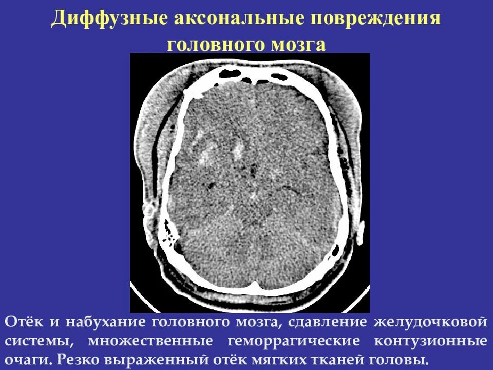 Аксональное повреждение мозга. Диффузно аксональные повреждения головного мозга кт. Контузионный очаг мозга кт. Очаги ушиба головного мозга на кт. Контузионный очаг 1 типа на кт.