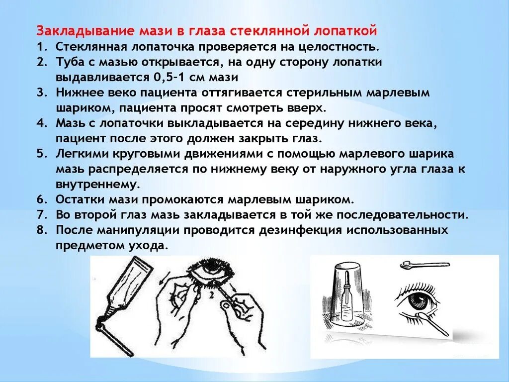 Алгоритм закладывания в глаза. Закладывание глазной мази алгоритм. закладывание мази за веко алгоритм. закладывание глазной мази на нижнее веко. техника закладывания мази в глаза алгоритм.