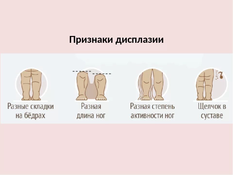 Дисплазия сустава у новорожденного лечение. Признаки дисплазии ТБС У детей. Дисплазия тазобедренных суставов складки. Дисплазия тазобедренного сустава клиника. Дисплазия тазобедренных суставов симптомы.