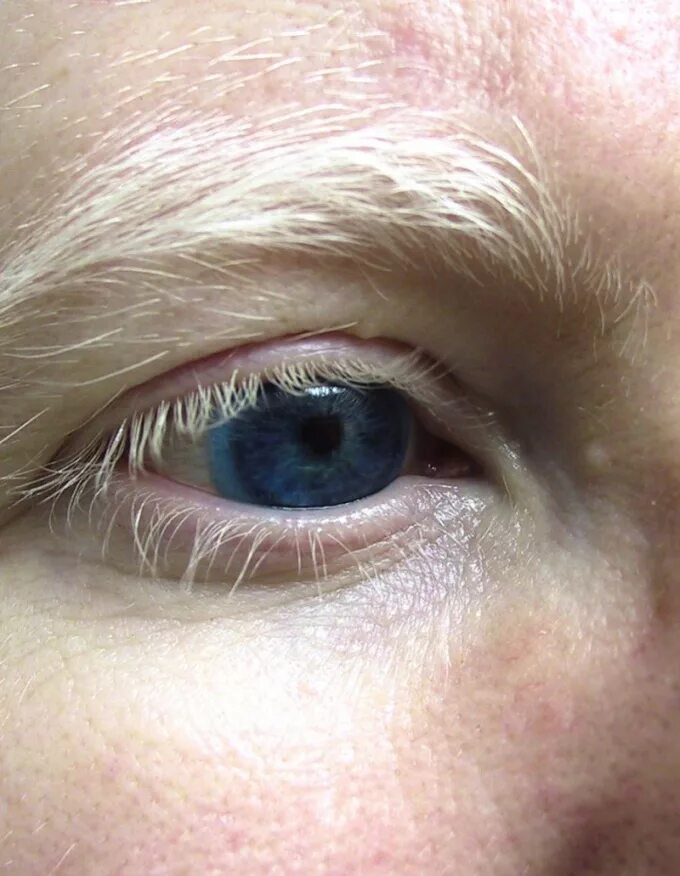 Окулокутанный альбинизм. Без пигмента. Альбинизм офтальмология. Глазокожный альбинизм тип 1а. Альбинизм красные глаза.