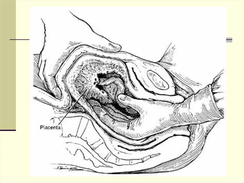 Ручное отделение плаценты и выделение последа. Ручное отделение плаценты. Отделение последа вручную. Операция ручного отделения плаценты. Способы ручного отделения плаценты.