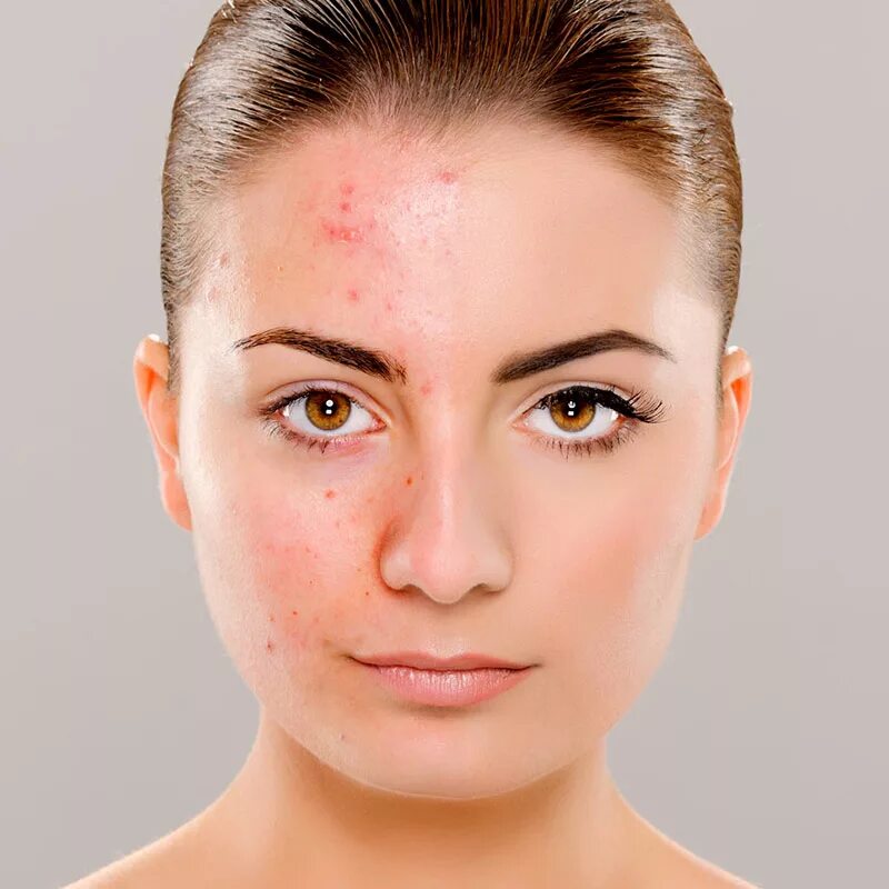 Девушка с проблемной кожей. Девушка спроблемной кожейй. Acne program