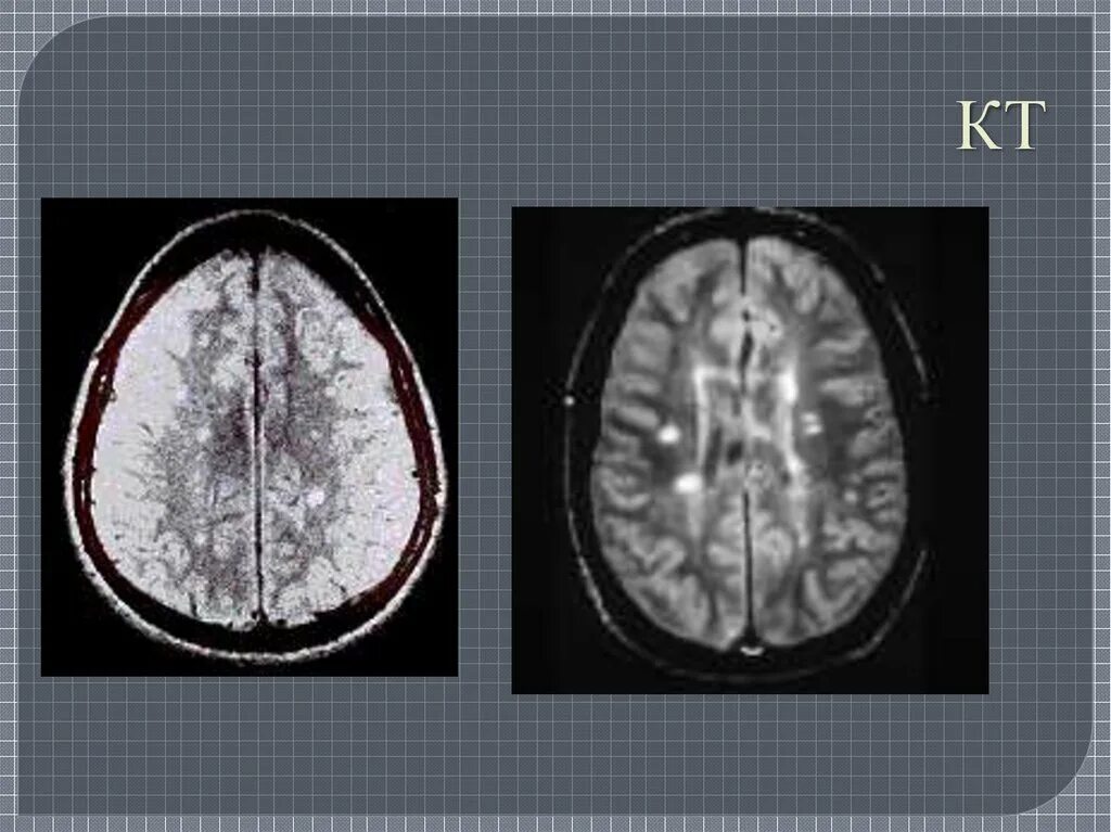 Демиелинизирующие заболевания головного мозга. G35 демиелинизирующее заболевание. Демиелинизирующее заболевание кт. Демиелинизирующие заболевания мозга на кт. Демиелинизация головного