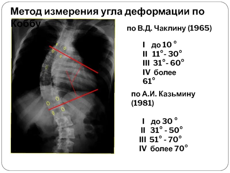 Угол Кобба степени сколиоза. Сколиотическая деформация по чаклину. Степени искривления позвоночника по коббу. Метод измерения угла деформации по коббу. Угол кобба