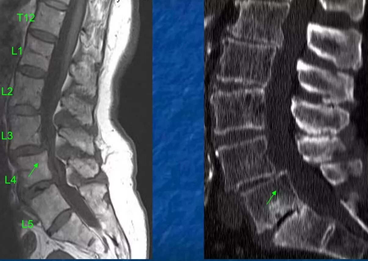 Спондилолиз l5. Спондилолистез пояснично-крестцового отдела позвоночника. Спондилолиз дужки l5. Спондилолиз l5 позвонка на кт. Картина спондилеза