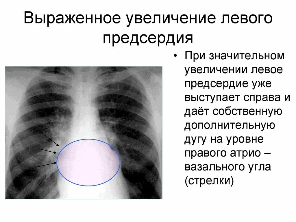 Дилатация левого предсердия. Умеренная дилатация левого предсердия. Дементация левого предсердия. Незначительная дилатация левого предсердия что это такое. Увеличено правое предсердие