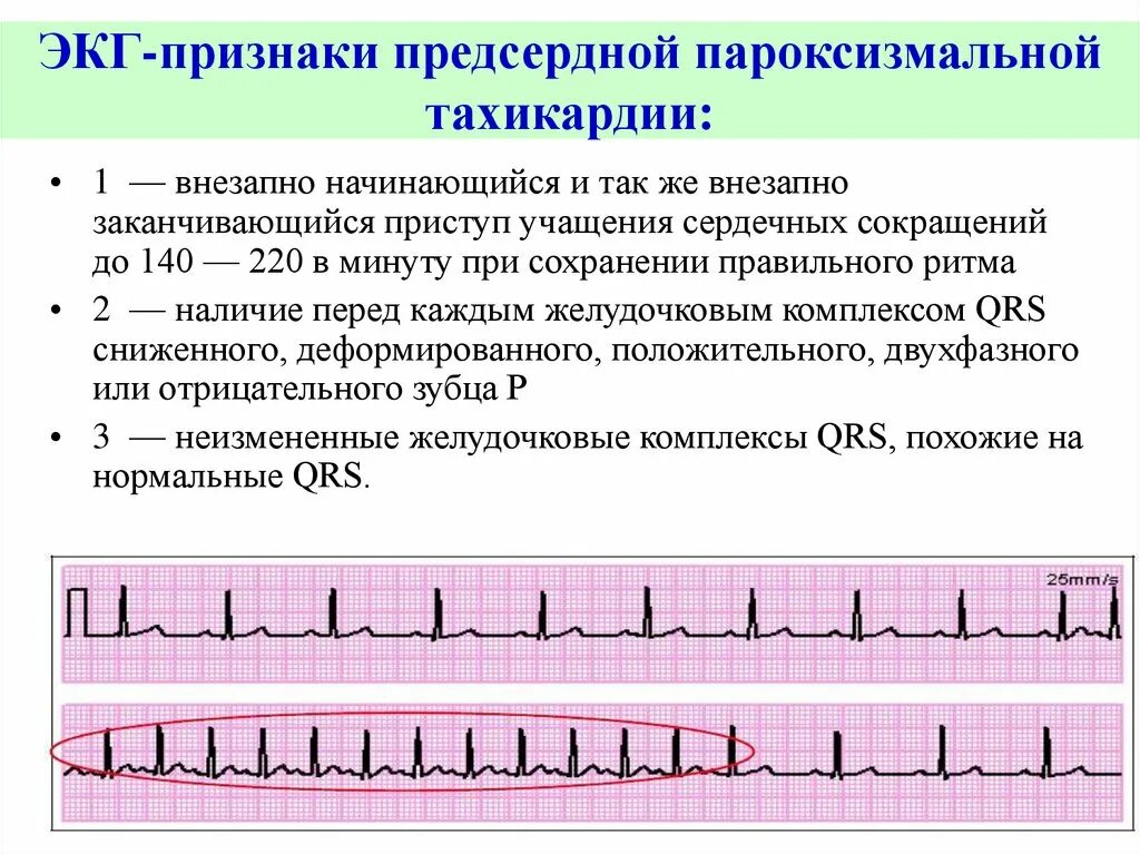 Какой ритм при пароксизмальной тахикардии. Какой ритм при пароксизмальной тахикардии