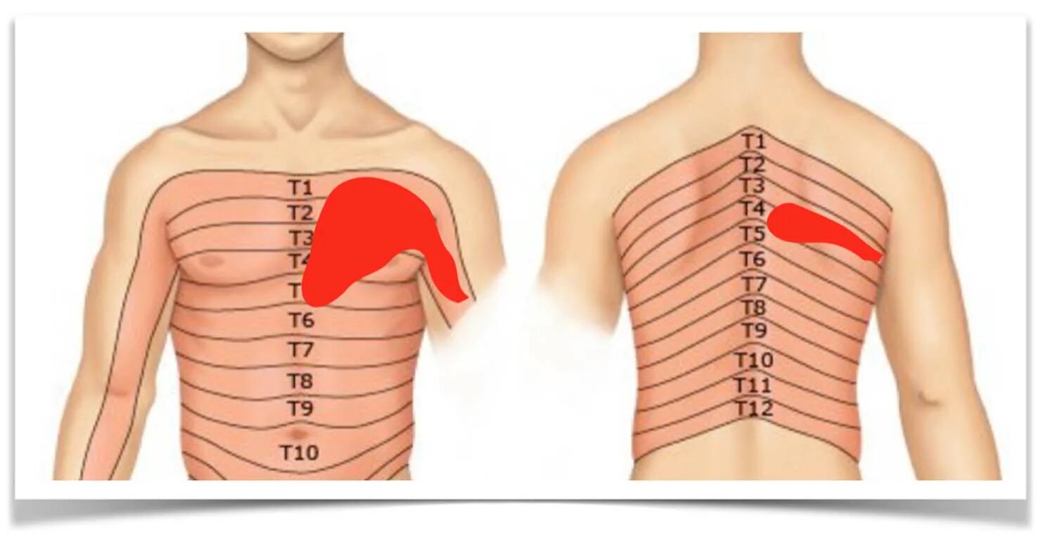 В груди сердце на спине. Межреберная невралоги. Реберная невралгия. Межрёберна яневралгия. Межреберная невралгия боль.