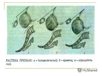Симптом вастена