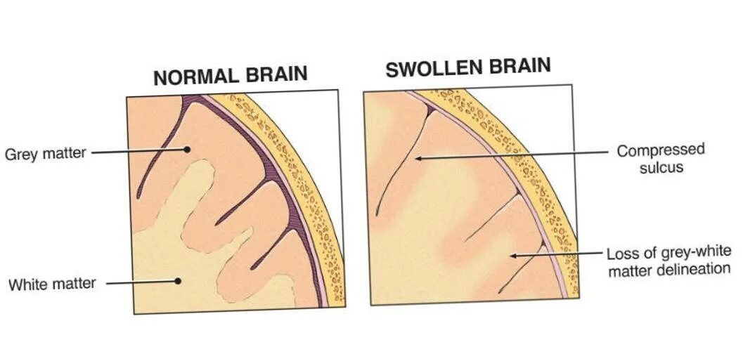Что означает отек мозга. Патогенез отека головного мозга схема. Отек набухание головного мозга. Отёк и набухание головного мозга. Отек оболочек головного мозга.