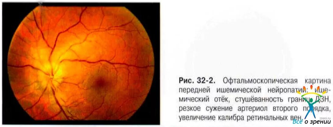 Ишемическая нейропатия зрительного нерва. Передняя ишемическая оптическая нейропатия. Ишемия диска зрительного нерва. Передняя ишемическая нейропатия глазное дно. Передняя ишемическая нейропатия