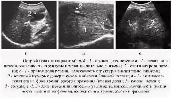 Печень толщина правой и левой доли норма. Узи печени нормальные показатели у взрослых таблица мужчин. Норма узи желчного пузыря у женщин. Норма размеров печени. Нормы размеров печени по узи у детей.