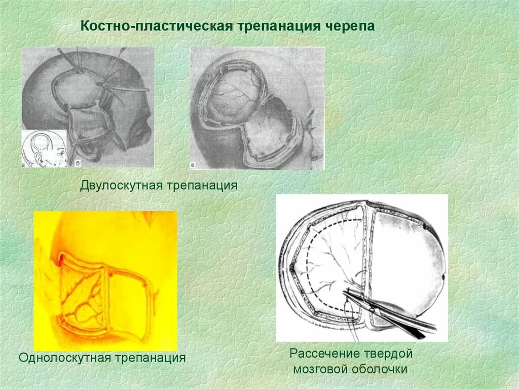 Костно-пластическая Трепанация черепа по Оливекрону. Костно пластическая Трепанация черепа по Вагнеру Вольфу. Декомпрессивная Трепанация черепа. Топографическая анатомия костно-пластическая Трепанация черепа.