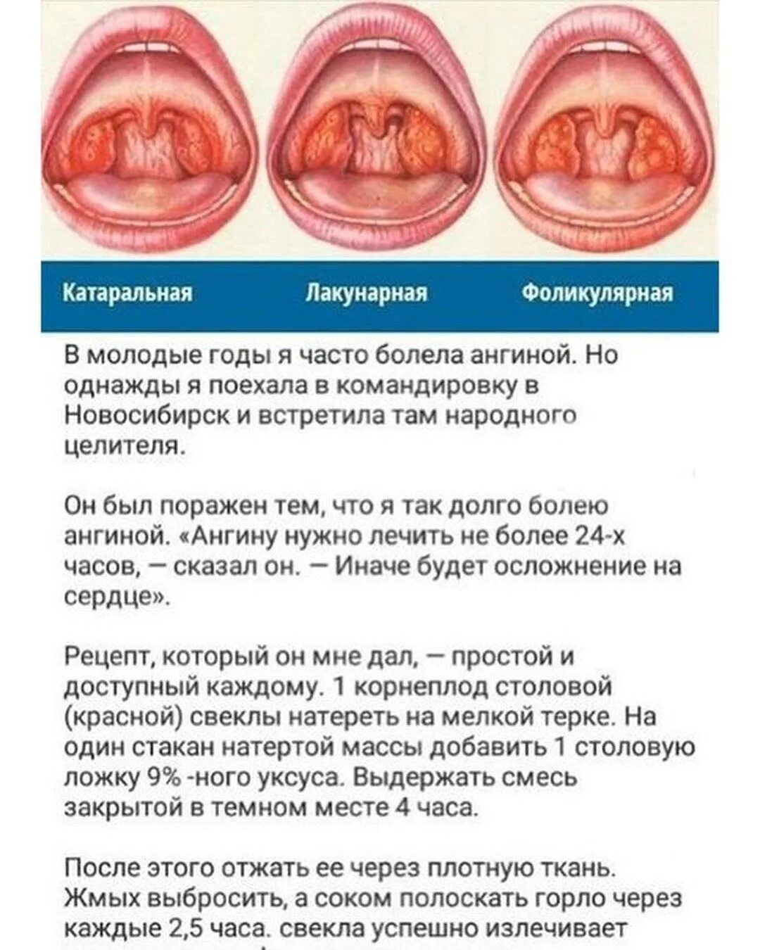 Можно ли пить при фарингите