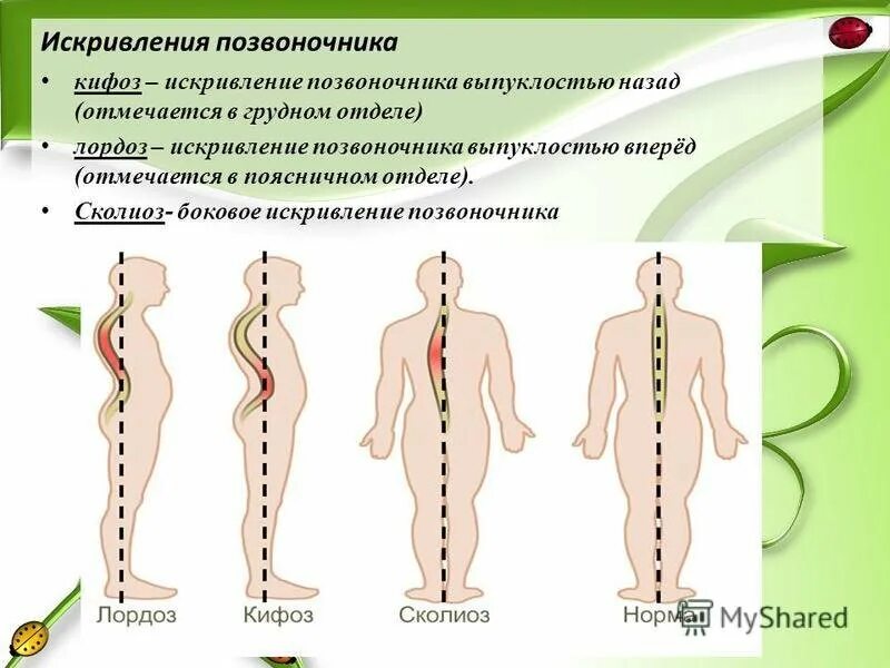 Нарушение изгиба позвоночника. Искривление позвоночника сколиоз и лордоз. Искривление позвоночника лагдох сктфох. Искривление позвоночника лордоз кифоз сколиоз. Лордоз кифоз сколиоз.