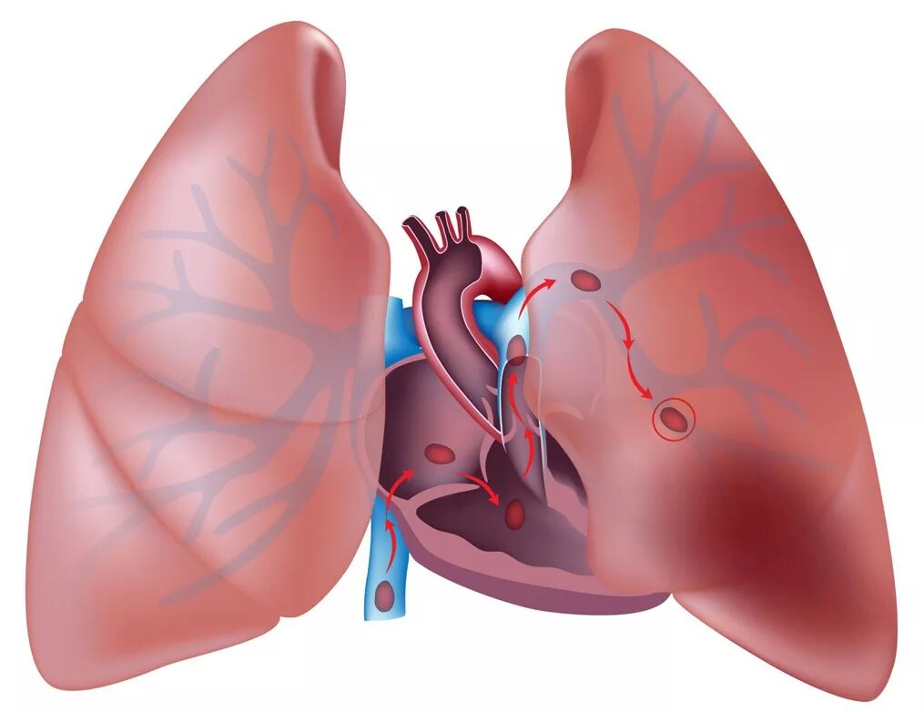 Тромбоалия лёгочной артерии. Тромбоэмболия легочной артерии. Тромбоэмболия а8 легочной артерии. Тромбоэмболия легочной артерии (Тэла). Оторвался тромб в легких