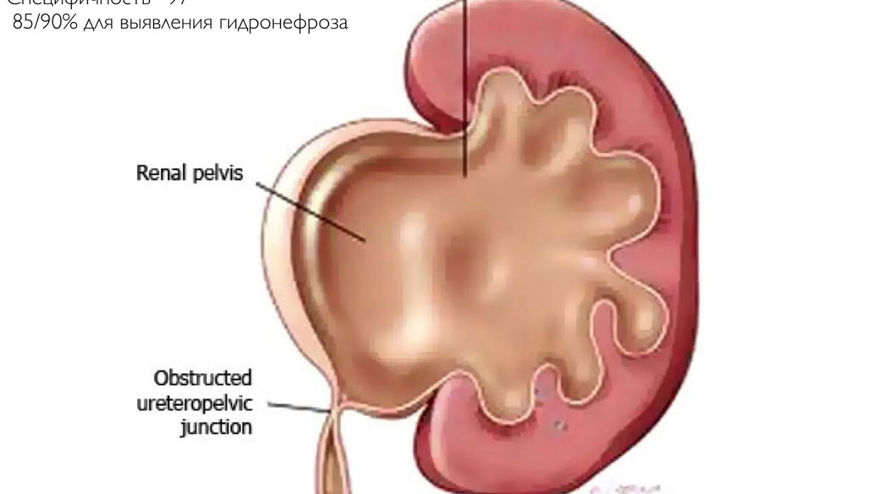 Заболевание почек гидронефроз. Врожденный гидронефроз почки. Расширение лоханки гидронефроз. Расширение лоханки почки. Пиело-каликоэктазия-гидронефротическая трансформация почки..