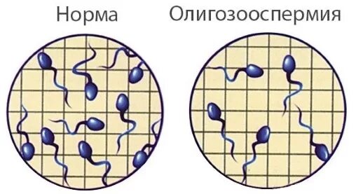 Олигоспермия это. Причины олигоспермии. Олигоспермия это. Спермограмма олигозооспермия. Олигоспермия это.