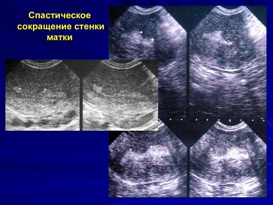 Миома матки гиперплазия эндометрия. Интрамуральная лейомиома матки 14 мм. Ультразвуковая диагностика миомы матки. Сокращение стенок матки.