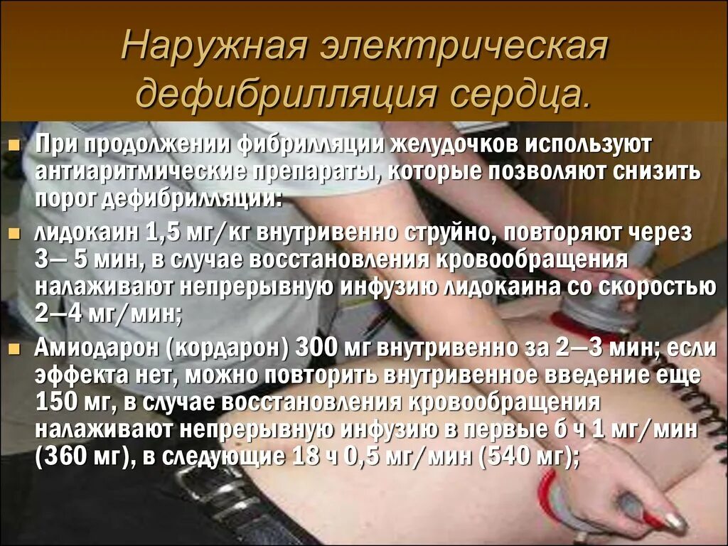 Проведение дефибрилляции сердца. Препараты при дефибрилляции. электрическая дефибрилляция сердца. лидокаин дефибрилляция. лидокаин при дефибрилляции.