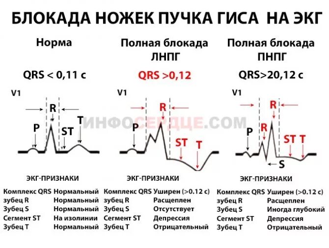 Признаки неполной блокады. Признаки блокады левой ножки пучка Гиса на ЭКГ. Признаки блокад ножек Гиса на ЭКГ. Блокада ЛНПГ на ЭКГ. Блокада левой ножки пучка Гиса на ЭКГ.