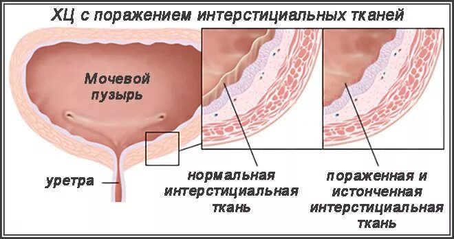 Первичный и вторичный цистит. Синдром болезненного мочевого пузыря. Интерстициальный цистит лечение. Интерстициальный цистит у женщин. Синдром раздраженного мочевого пузыря у женщин симптомы.