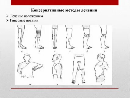 Повязки травматология