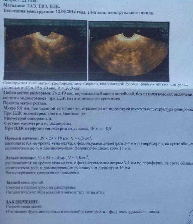 УЗИ матки беременность 21 день цикла. УЗИ беременность эндометрий 9 мм. УЗИ полости матки, яичников. Эндометрий по УЗИ 12 день цикла.