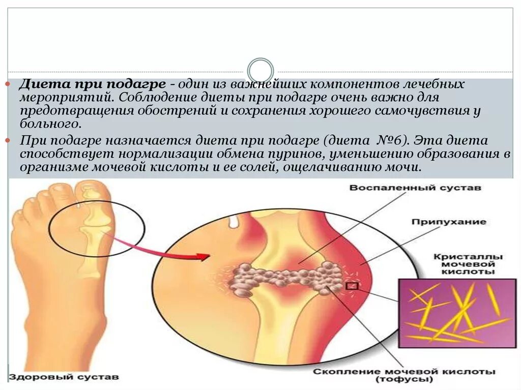 Что употреблять при подагре. Подагра диета. питание при подагре. таблица питания при подагре. диета при подагре таблица.
