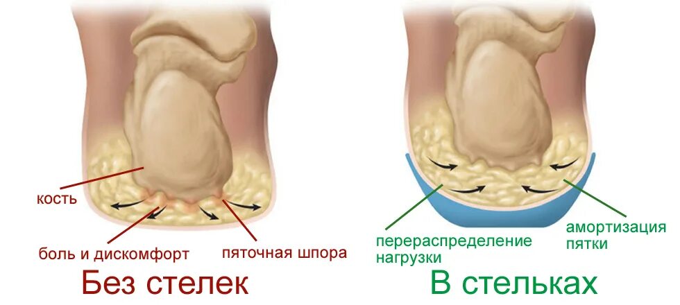 Пятка амортизирует. Стельки при пяточной шпоре. Амортизация костей