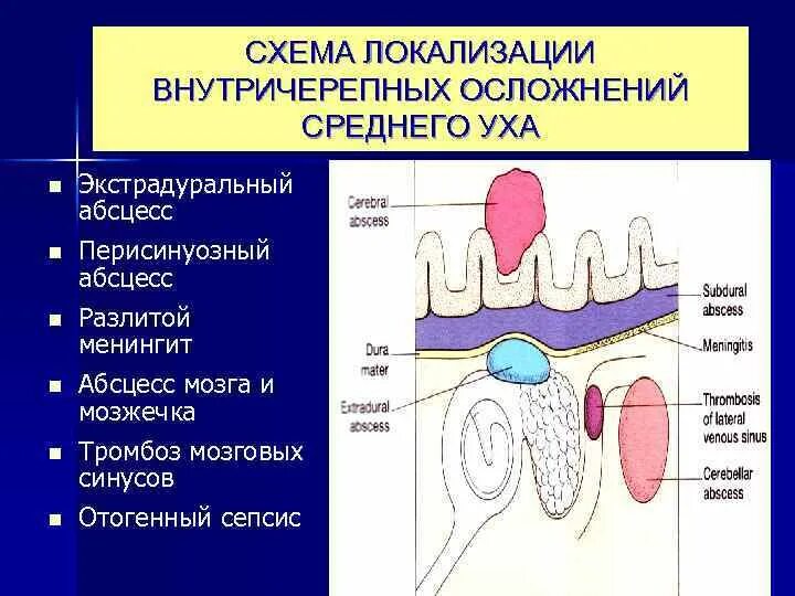 Схема осложнения. Экстрадуральный абсцесс локализации. Внутричерепные осложнения среднего уха. Перисинуозный абсцесс.