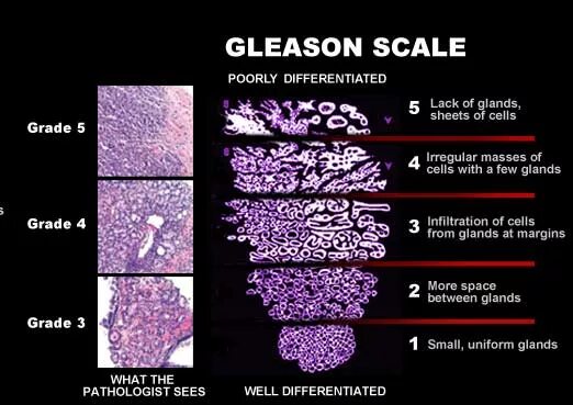 Глисон простата. Шкала Grade онкология. Классификация Глисона. Классификация Глисон предстательной железы. Grade 3 в онкологии что это.