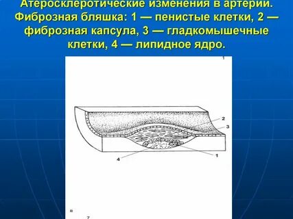 Фиброзная капсула