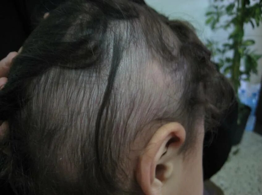 Очаговая алопеция (alopecia Areata). Очаговая (гнездная) алопеция. Волосы на лбу ребенка