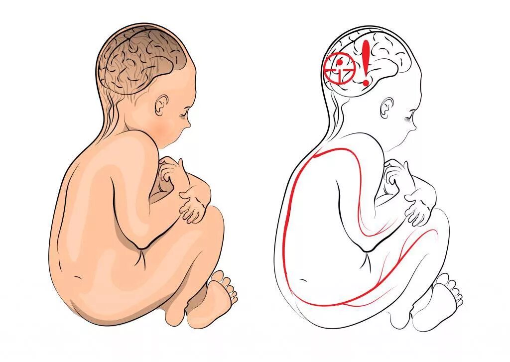 Дцп мозг. Церебральный паралич у новорожденных. Нарушение развития плода.
