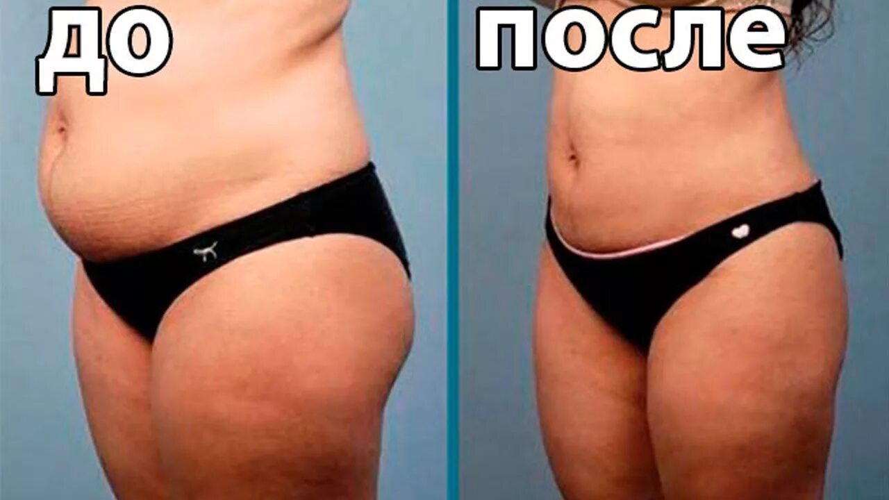 Липосакция живота отзывы фото до и после: найдено 80 изображений