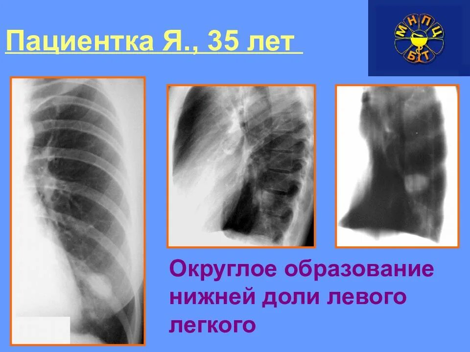 Затемнение в левом легком. Образование нижней доли левого легкого. Затемнение доли легкого. Округлое образование в легких на рентгене. Затемнение нижних долей легких.