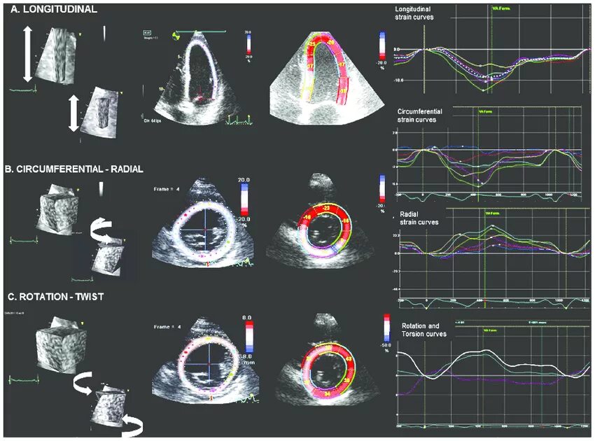 Стрейн – эхокардиография. Что такое спекл трекинг ЭХОКГ. Speckle tracking эхокардиография методика. Strain в эхокардиографии. Эхо кс цена