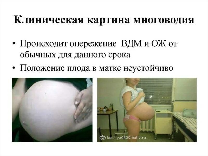 Живот каменеет при беременности 3 триместр. Многоводие симптомы в 3 триместре беременности. причины многоводия при беременности. клиническая картина многоводия. что такое многоводия у беременных.
