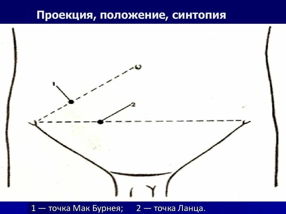 Точки аппендицита. Мак Бурнея и Ланца. Точка Мак Бурнея при аппендиците. Точка Мак Бернея и точка Ланца. Болевые точки Мак Бурнея Ланца.