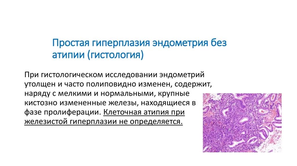 Клетки без признаков атипии. Простая гиперплазия эндометрия гистология. Пролиферация клеток эпителия эндоцервикса. Простая гиперплазия эндометрия без атипии гистология. Атипическая гиперплазия эндометрия гистология.