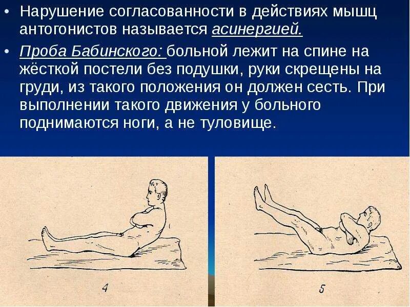 Нарушение функции мозжечка. Проба Бабинского при поражении мозжечка. Асинергия Бабинского. Асинергия, атаксия. Исследование асинергии Бабинского.