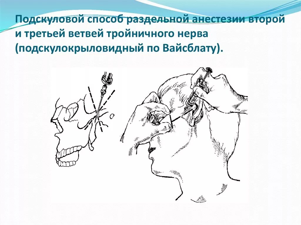 Блокада тройничного. Подскулокрыловидный путь анестезии по Вайсблату. Обезболивание верхнечелюстного нерва (стволовая анестезия). Подскуловой путь анестезии верхнечелюстного нерва. Стволовая анестезия нижнечелюстного нерва.