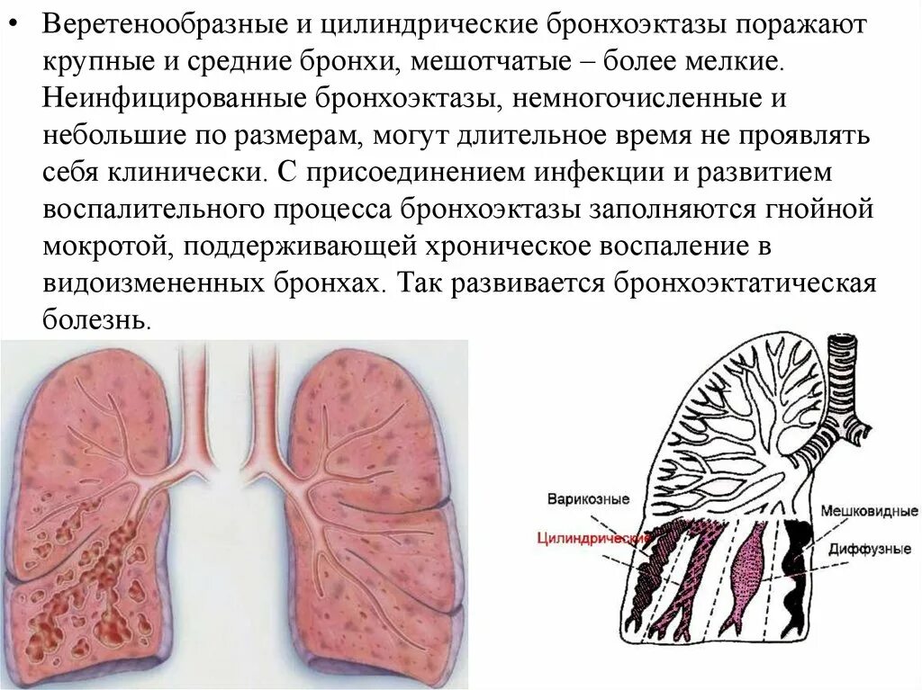 Бронхит бронхоэктатическая болезнь. Бронхоэктазы в легких мешотчатые. Бронхоэктатическая болезнь:бронхоэктатическая болезнь. Цилиндрические и мешотчатые бронхоэктазы. Хронический бронхит и бронхоэктатическая болезнь.