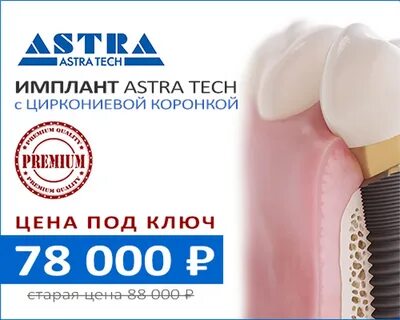 Astra имплант отзывы